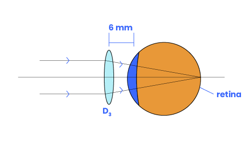 A vertex compensated lens focuses the image onto the retina.